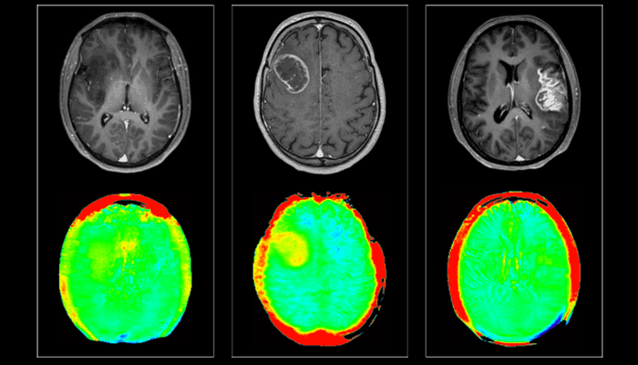 3d apt neuro oncology