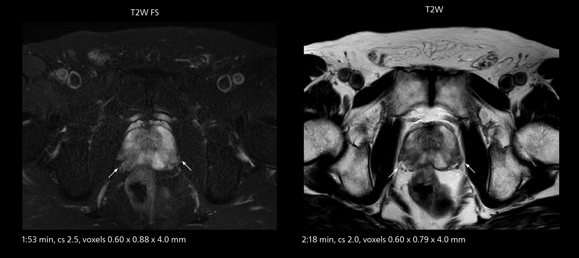 Prostate mri one