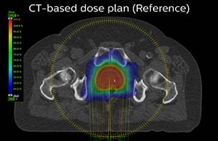 Turku CT based dose plan as reference case 8