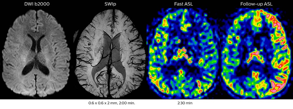 Acute right motor deficit and aphasia