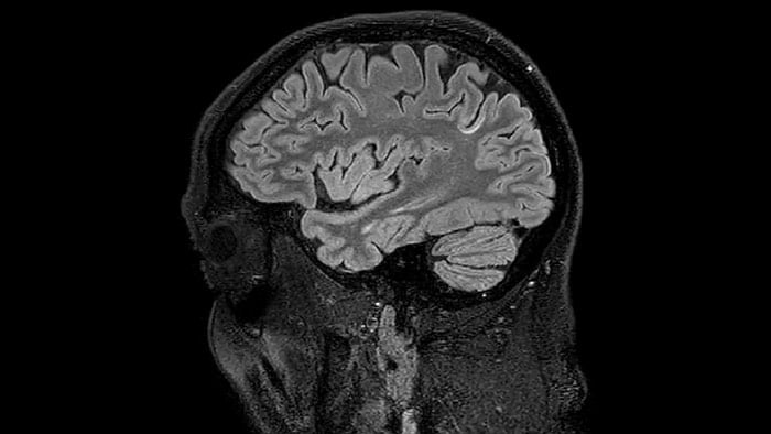 Juxtacortical MS lesion elition