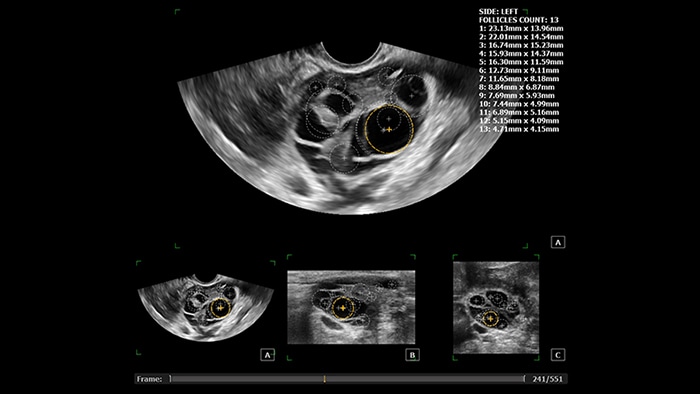 Ultrasound imaging