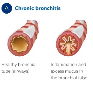 Chronic bronchitis