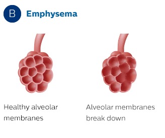 Emphysema