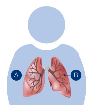 What is COPD