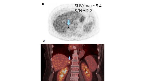 lung cancer image zwolle