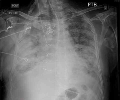 CXR transducer