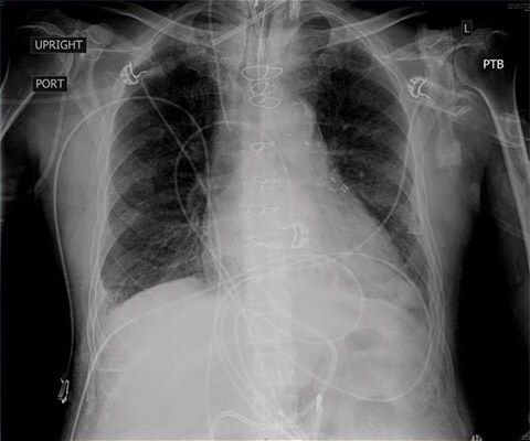 CXR transducer